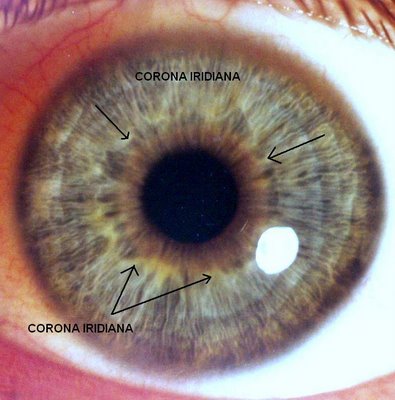Iridologia: Corona iridiana